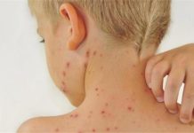 تسجيل حالات “جرب”.. وزارة الصحة تخرج عن صمتها تسجيل حالات “جرب”.. وزارة الصحة تخرج عن صمتها