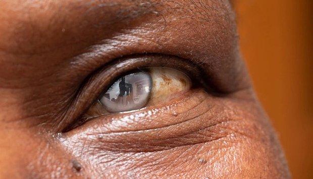 Cataract is one of the main vision problems in the country Cataract is one of the main vision problems in the country