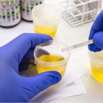 Glycosurie: Causes, Symptômes, Diagnostic et Prise en Charge Glycosurie: Causes, Symptômes, Diagnostic et Prise en Charge