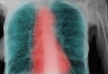 Facteurs Déterminants de la BPCO Chez les Fumeurs Facteurs Déterminants de la BPCO Chez les Fumeurs