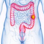 Hausse Du Cancer Colorectal Chez Les Jeunes Identifiée Hausse Du Cancer Colorectal Chez Les Jeunes Identifiée
