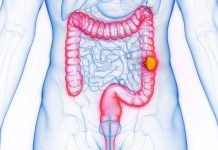 Hausse Du Cancer Colorectal Chez Les Jeunes Identifiée Hausse Du Cancer Colorectal Chez Les Jeunes Identifiée