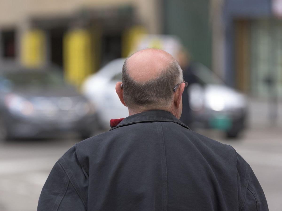Chute de cheveux : découverte de nouveaux variants génétiques de l'alopécie chez l'homme Chute de cheveux : découverte de nouveaux variants génétiques de l'alopécie chez l'homme