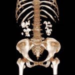 Découverte Inattendue sur les Calculs Rénaux Découverte Inattendue sur les Calculs Rénaux