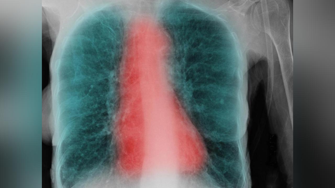 Facteurs Déterminants de la BPCO chez les Fumeurs Facteurs Déterminants de la BPCO chez les Fumeurs
