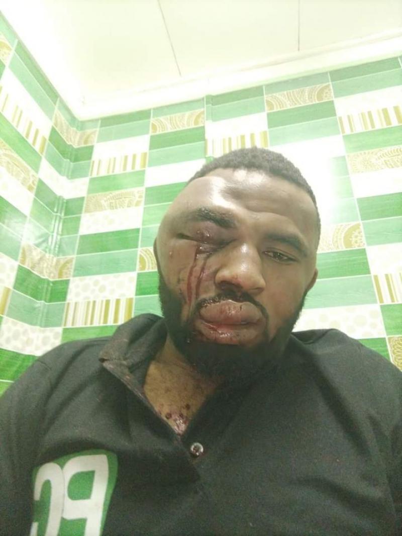 Cameroun: Le lanceur d’alertes Paul Chouta à l’article de la mort après avoir subi une sauvage agression. Cameroun: Le lanceur d’alertes Paul Chouta à l’article de la mort après avoir subi une sauvage agression.