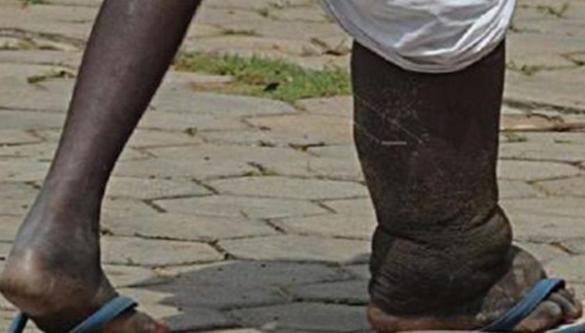 Cameroun : un accord de plus de 40 milliards de F pour lutter contre les Maladies Tropicales Négligées Cameroun : un accord de plus de 40 milliards de F pour lutter contre les Maladies Tropicales Négligées