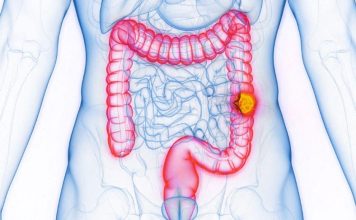 Hausse Du Cancer Colorectal Chez Les Jeunes Identifiée Hausse Du Cancer Colorectal Chez Les Jeunes Identifiée