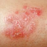 Le Psoriasis: Définition, SymptôMes, Traitement Le Psoriasis: Définition, SymptôMes, Traitement