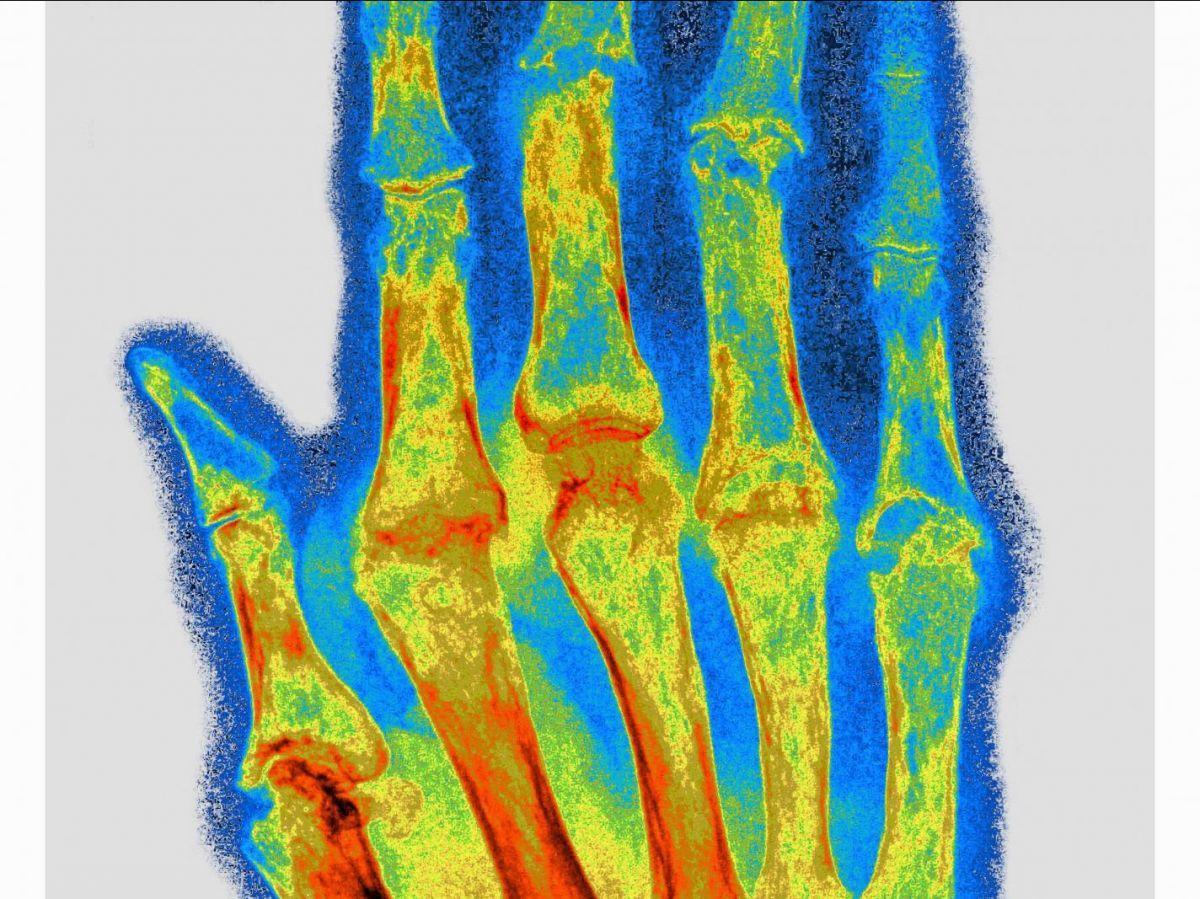 Vers un Implant pour Soigner la Polyarthrite RhumatoïDe? Vers un Implant pour Soigner la Polyarthrite RhumatoïDe?