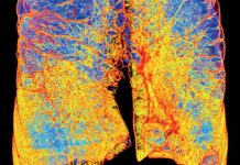 Poumons: BPCO, L’épidémie Silencieuse Poumons: BPCO, L'épidémie Silencieuse