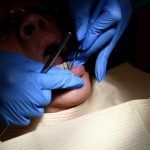 Caries Dentaires Vers Le Remboursement De Quatre Traitements Caries Dentaires Vers Le Remboursement De Quatre Traitements