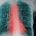 Facteurs Déterminants de la BPCO Chez les Fumeurs Facteurs Déterminants de la BPCO Chez les Fumeurs