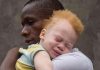 Albinism Stigma Myths and Ritualistic Fears Albinism Stigma Myths and Ritualistic Fears