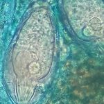 New Schistosomiasis Outbreak Confirmed in São Miguel New Schistosomiasis Outbreak Confirmed in São Miguel