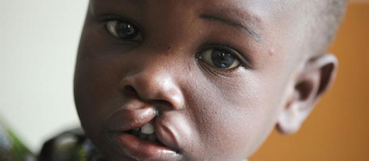 Centrafrique : lancement d’une semaine de sensibilisation et de prise en charge des fentes