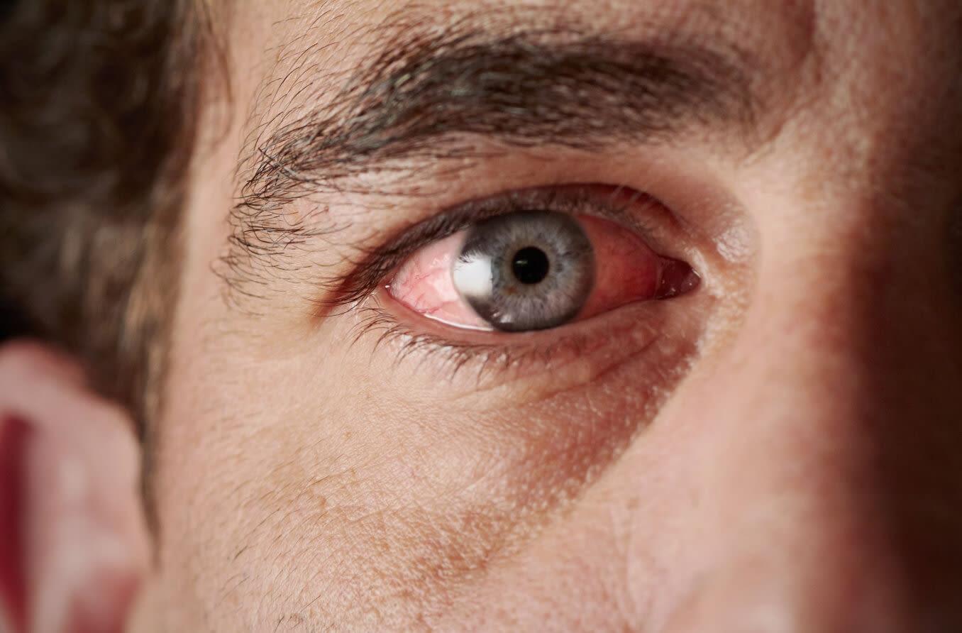 Œil rouge : quelles sont les causes ? Œil rouge : quelles sont les causes ?