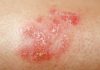 Le Psoriasis: Définition, SymptôMes, Traitement Le Psoriasis: Définition, SymptôMes, Traitement