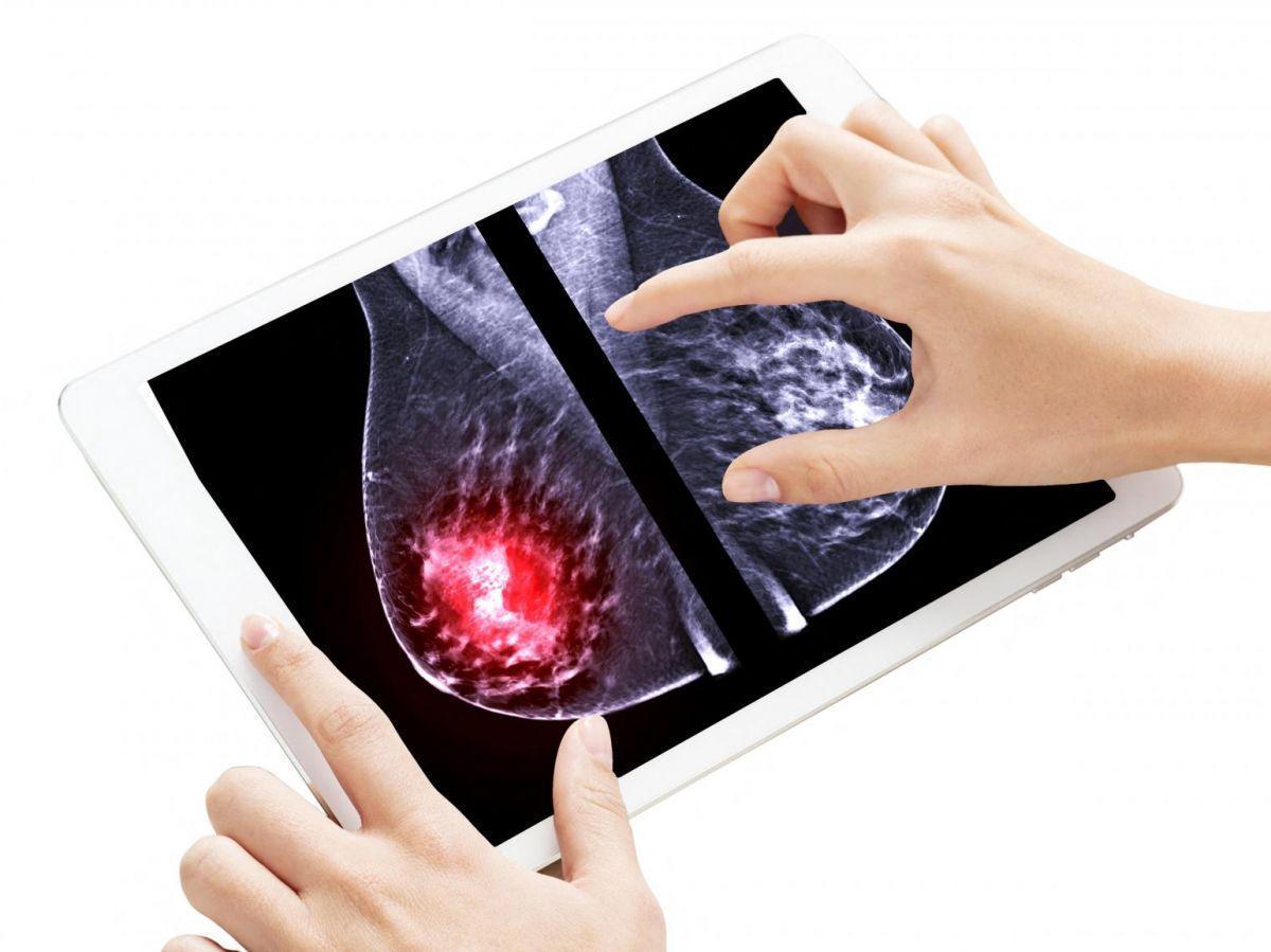 Quart des Femmes Diagnostiquées Ont Moins de 50 Ans Quart des Femmes Diagnostiquées Ont Moins de 50 Ans