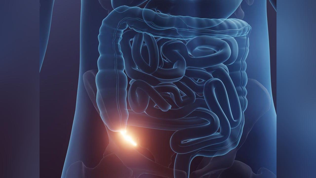 Efficacité des Antibiotiques pour Traiter L’Appendicite Efficacité des Antibiotiques pour Traiter L’Appendicite