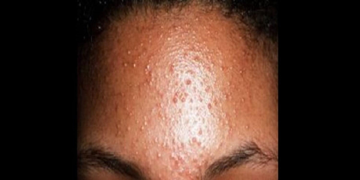 Beauté: 07 aliments qui favorisent les boutons Beauté: 07 aliments qui favorisent les boutons