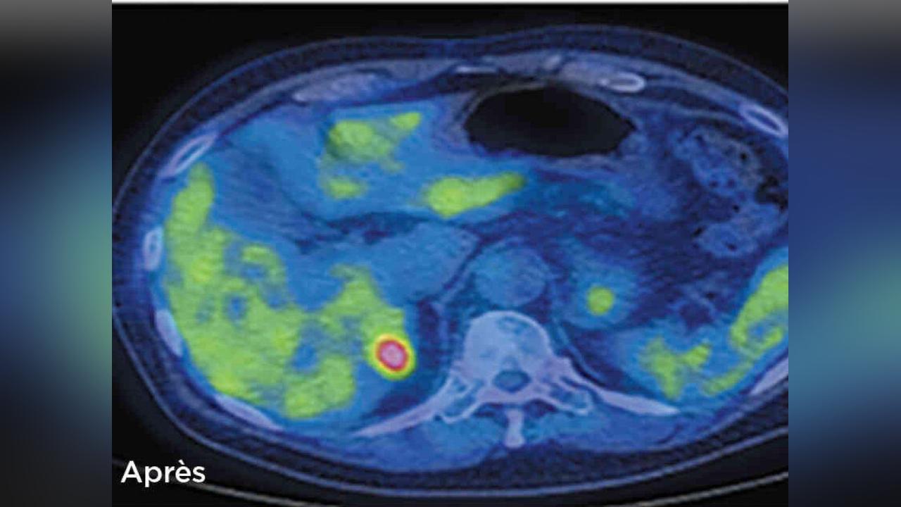 Cancer: Nouvelles Armes de L’Immunothérapie Cancer: Nouvelles Armes de L’Immunothérapie