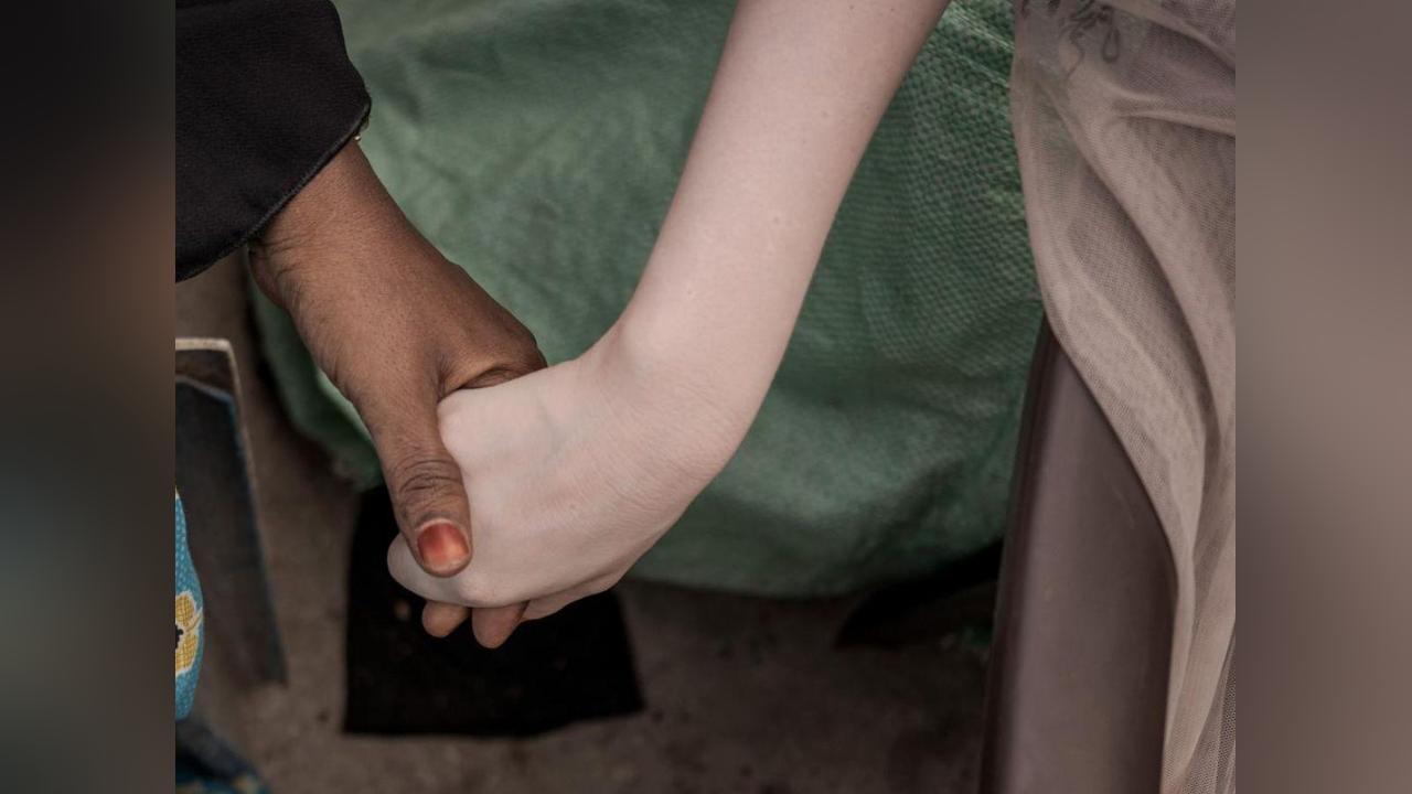 Gène Modulant la Couleur de la Peau Jusqu’à L’Albinisme Gène Modulant la Couleur de la Peau Jusqu’à L’Albinisme