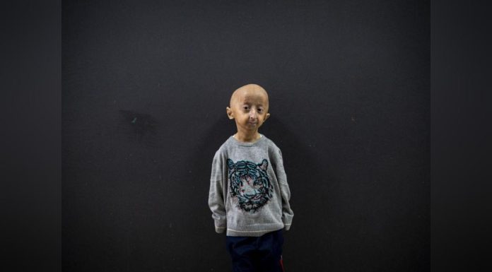 Gène de Centenaires Contre la Progéria Rarissime Gène de Centenaires Contre la Progéria Rarissime