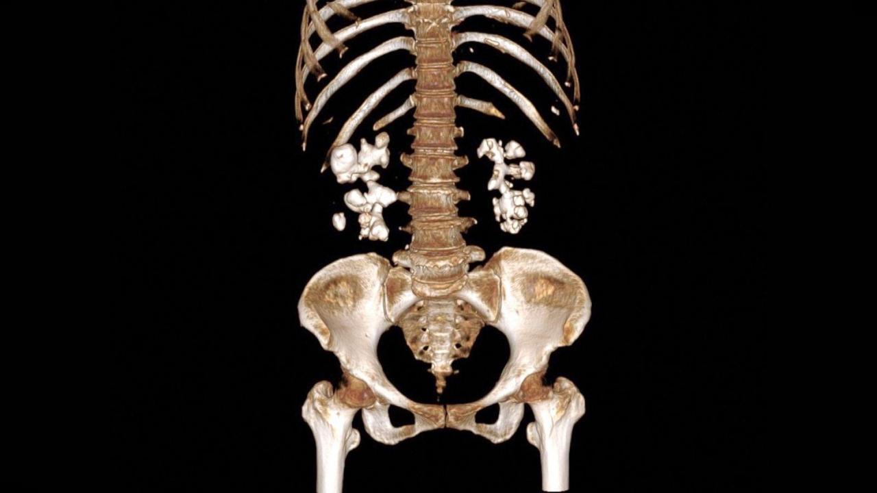 Découverte Inattendue sur les Calculs Rénaux Découverte Inattendue sur les Calculs Rénaux