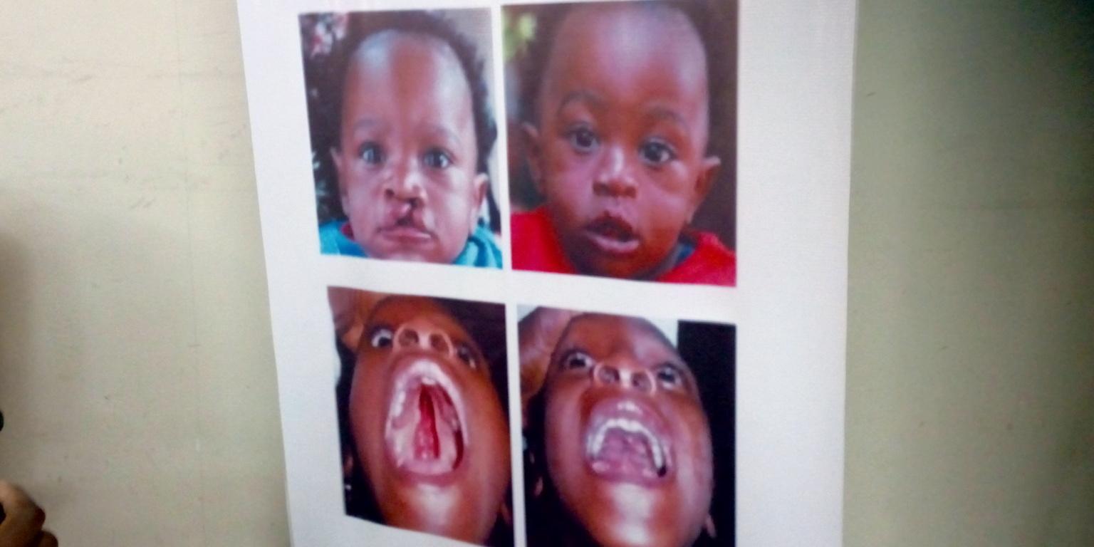 Fentes labio-palatines: des soins gratuits ouverts à Brazzaville Fentes labio-palatines: des soins gratuits ouverts à Brazzaville