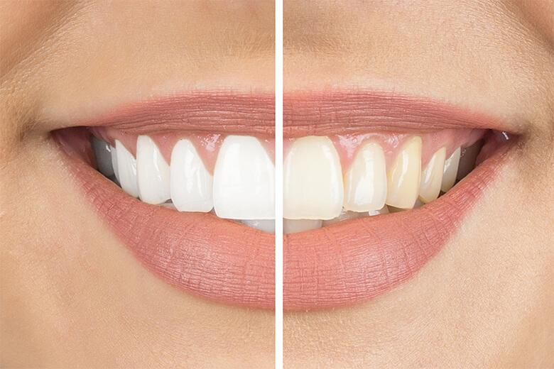 Halte à la dépigmentation des dents ! Halte à la dépigmentation des dents !