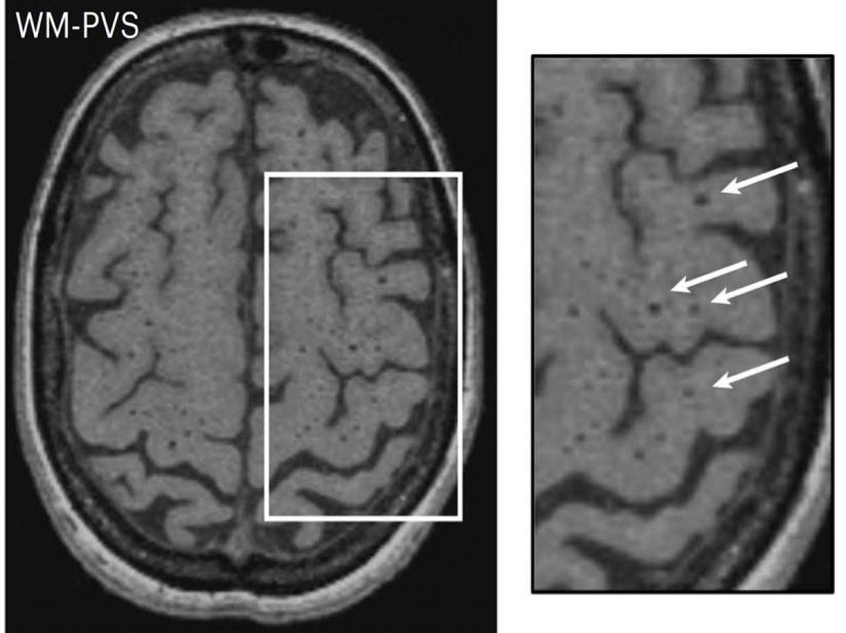Maladie des petites artères du cerveau : des avancées pour cette affection répandue et difficile à diagnostiquer Maladie des petites artères du cerveau : des avancées pour cette affection répandue et difficile à diagnostiquer