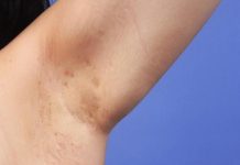 Maladie de Verneuil: 1 % de la Population Est Atteinte Maladie de Verneuil: 1 % de la Population Est Atteinte