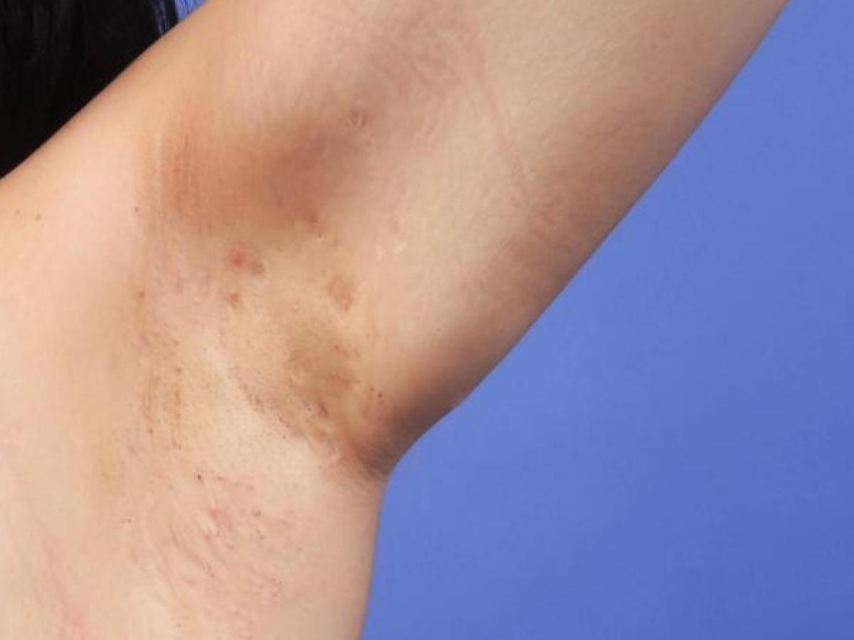 Maladie de Verneuil: 1 % de la Population Est Atteinte Maladie de Verneuil: 1 % de la Population Est Atteinte