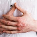 Eczéma: Fréquence de lavage n’affecte pas les symptômes Eczéma: Fréquence de lavage n'affecte pas les symptômes