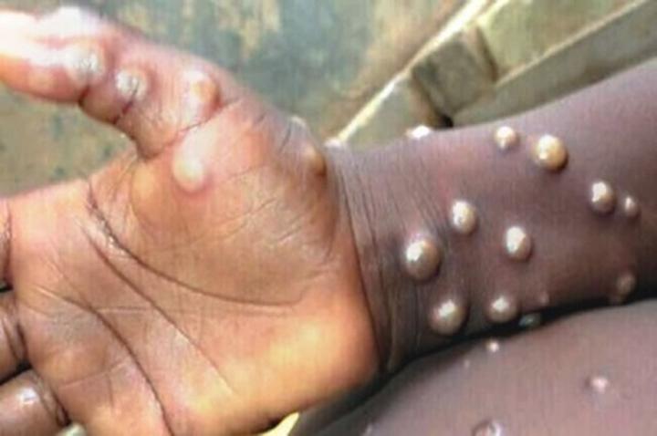 Kwilu : 37 cas de monkeypox notifiés et quelques décès signalés Kwilu : 37 cas de monkeypox notifiés et quelques décès signalés