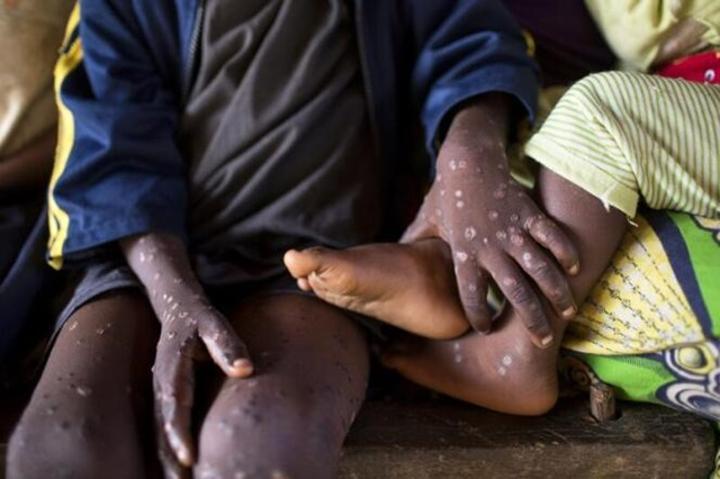 Variole du singe : 581 morts de mpox depuis janvier, nombre de cas record sur une année Variole du singe : 581 morts de mpox depuis janvier, nombre de cas record sur une année