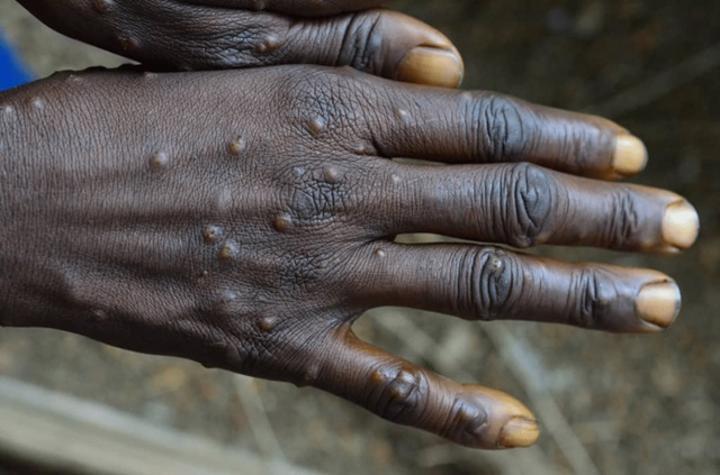La RDC, épicentre mondial de la variole du singe en 2023 La RDC, épicentre mondial de la variole du singe en 2023