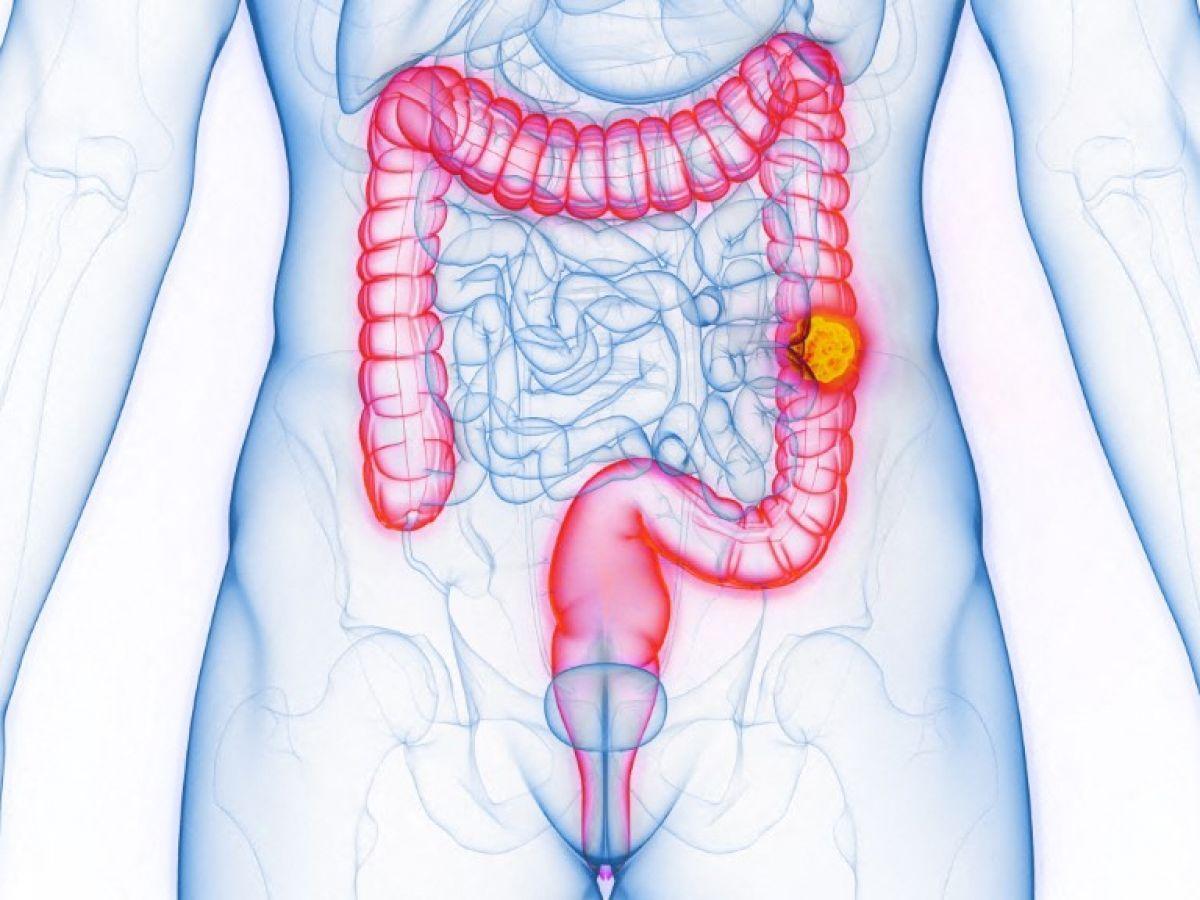 Hausse Du Cancer Colorectal Chez Les Jeunes Identifiée Hausse Du Cancer Colorectal Chez Les Jeunes Identifiée