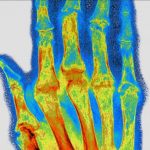 Vers un Implant pour Soigner la Polyarthrite RhumatoïDe? Vers un Implant pour Soigner la Polyarthrite RhumatoïDe?