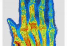 Vers un Implant pour Soigner la Polyarthrite RhumatoïDe? Vers un Implant pour Soigner la Polyarthrite RhumatoïDe?