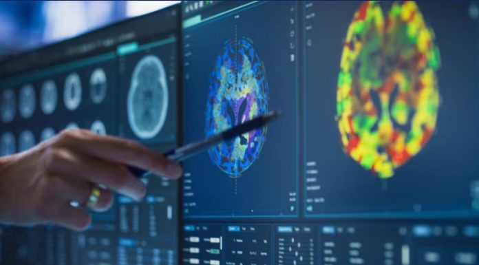 Sport Adoré Lié à un Risque Accru d’Alzheimer Sport Adoré Lié à un Risque Accru d'Alzheimer