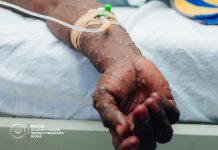 Mpox en RDC: 300 cas hebdomadaires, 19 foyers actifs Mpox en RDC: 300 cas hebdomadaires, 19 foyers actifs