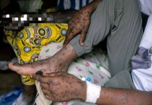 Décès à Lubutu Lié à la Variole du Singe Décès à Lubutu Lié à la Variole du Singe