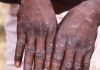 Riposte Intensifiée Contre Mpox au Sud-Kivu Riposte Intensifiée Contre Mpox au Sud-Kivu