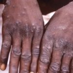 Riposte Intensifiée Contre Mpox au Sud-Kivu Riposte Intensifiée Contre Mpox au Sud-Kivu