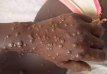 Alerte Rouge au Haut-Katanga pour Taux de Positivité Élevé Alerte Rouge au Haut-Katanga pour Taux de Positivité Élevé