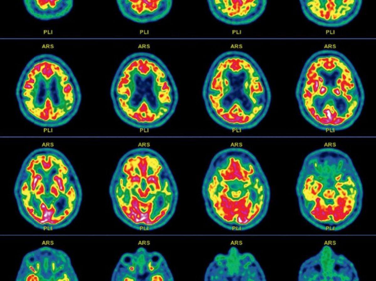 L'Amnésie Un Trouble Aux Multiples Causes L'Amnésie Un Trouble Aux Multiples Causes