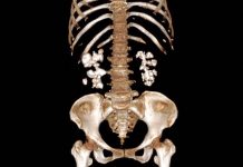 Découverte Inattendue sur les Calculs Rénaux et Traitements Découverte Inattendue sur les Calculs Rénaux et Traitements