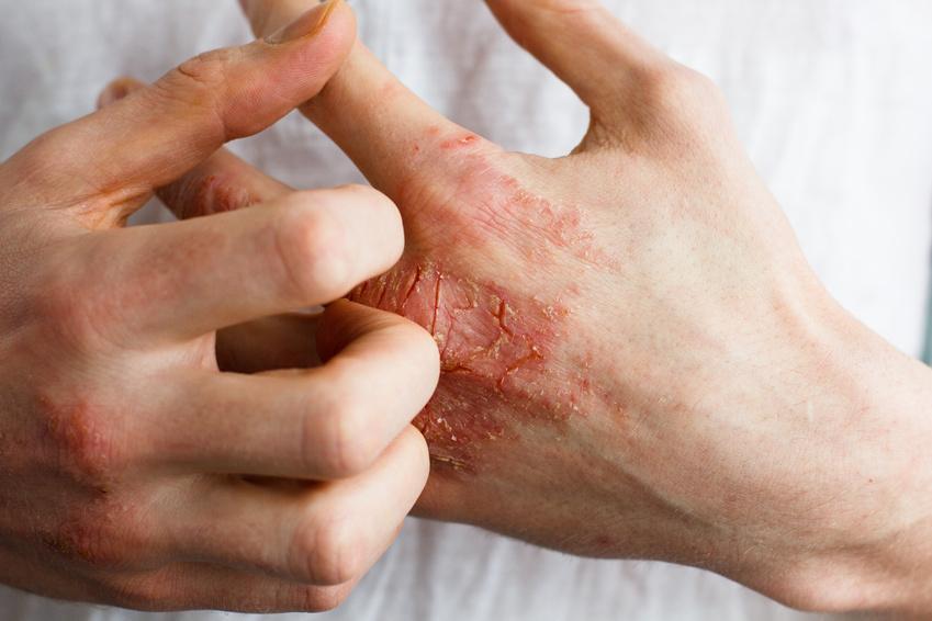 Eczéma : comment s’en débarrasser ? Eczéma : comment s’en débarrasser ?